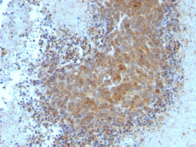FFPE human melanoma sections stained with 100 ul anti-Bax (clone BAX/962) at 1:100. HIER epitope retrieval prior to staining was performed in 10mM Tris 1mM EDTA, pH 9.0.